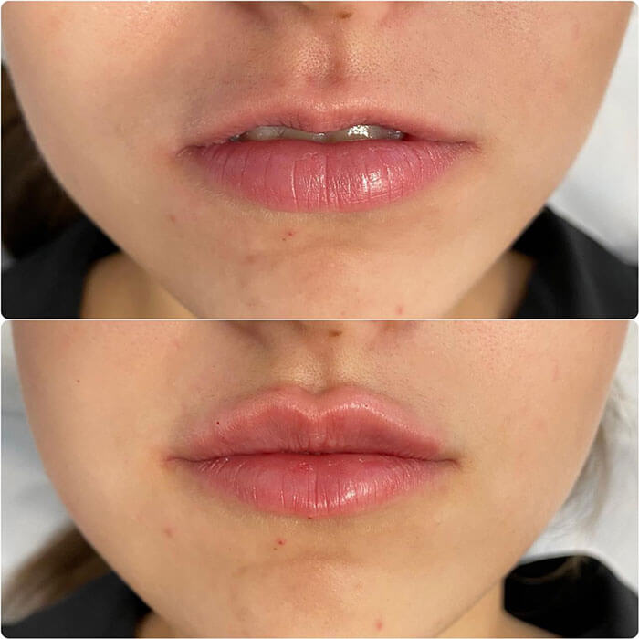 Увеличение губ Шмелёва Карина Олеговна